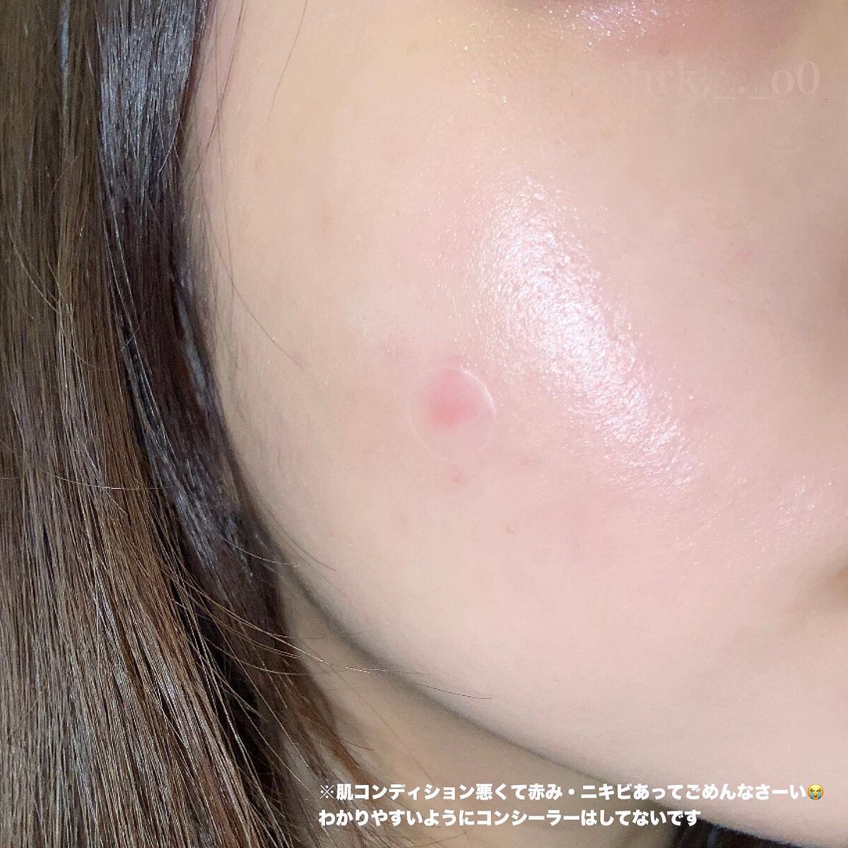 ティーツリーカーミングスポットパッチ/MEDIHEAL/その他スキンケアを使ったクチコミ（2枚目）