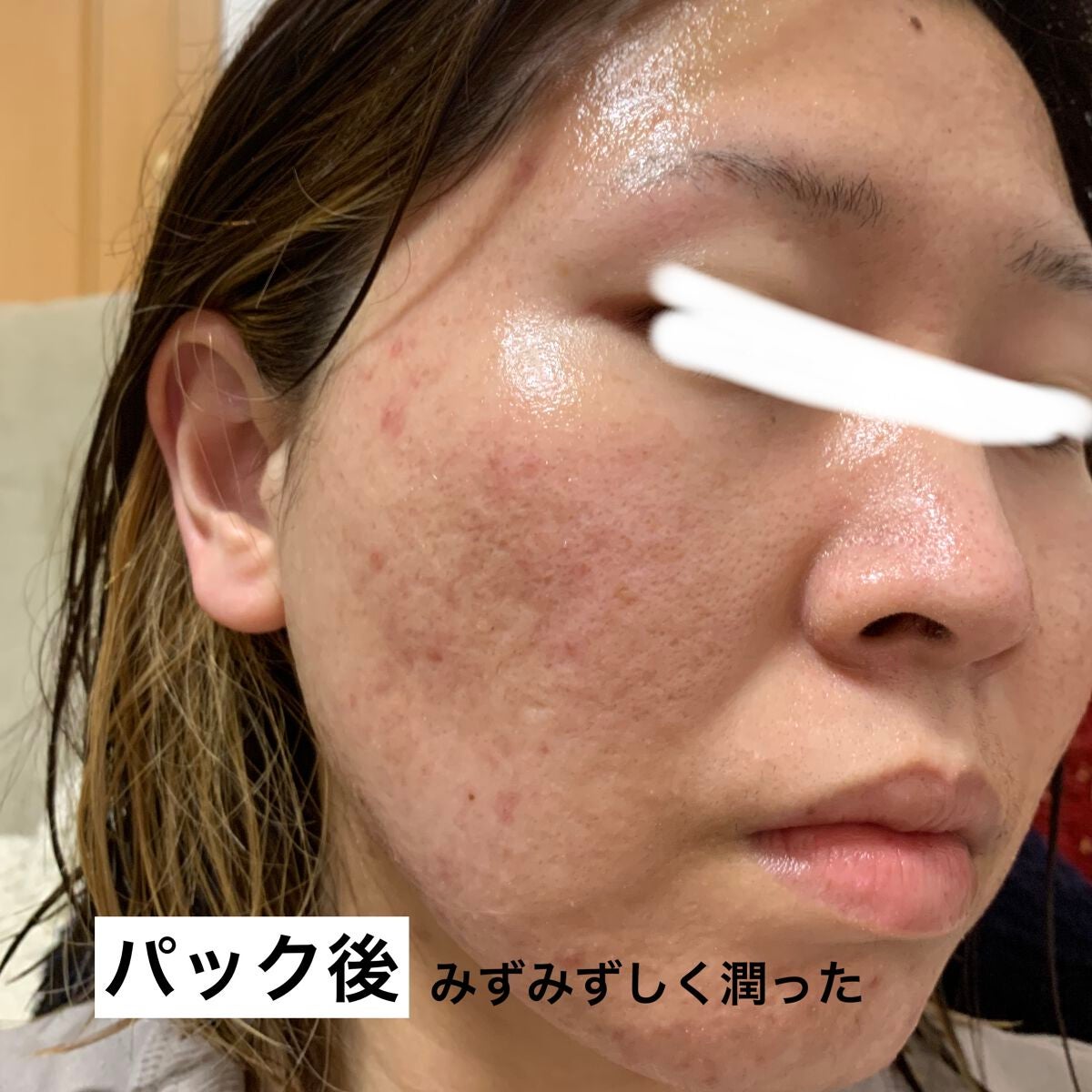 毛穴小町 テカリ源治 マスク/クリアターン/シートマスク・パックを使ったクチコミ(6枚目)