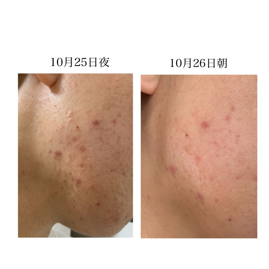 ペアアクネクリームW(医薬品)/ペア/その他を使ったクチコミ（2枚目）