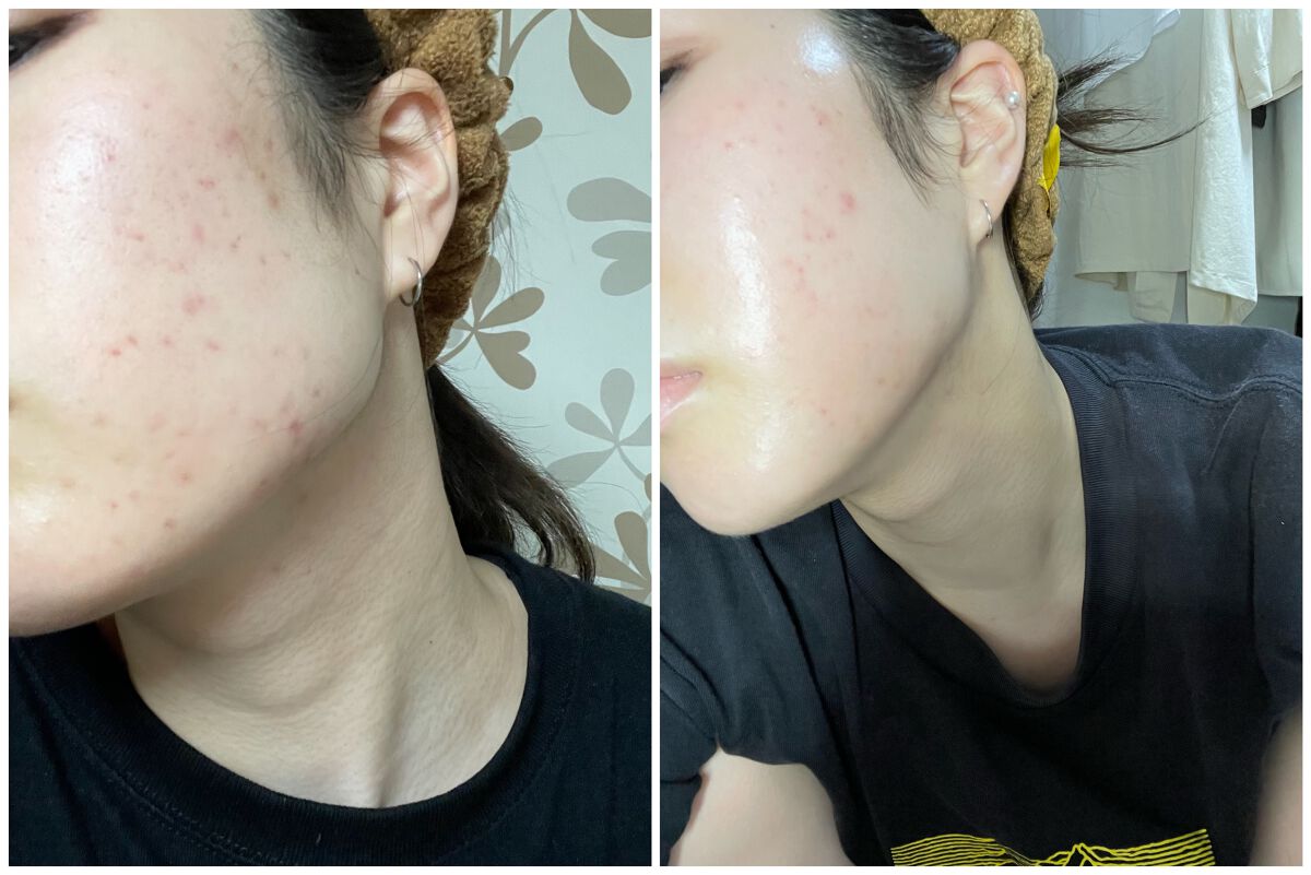 マジックティーツリーオイル/ブラン/フェイスオイルを使ったクチコミ(1枚目)