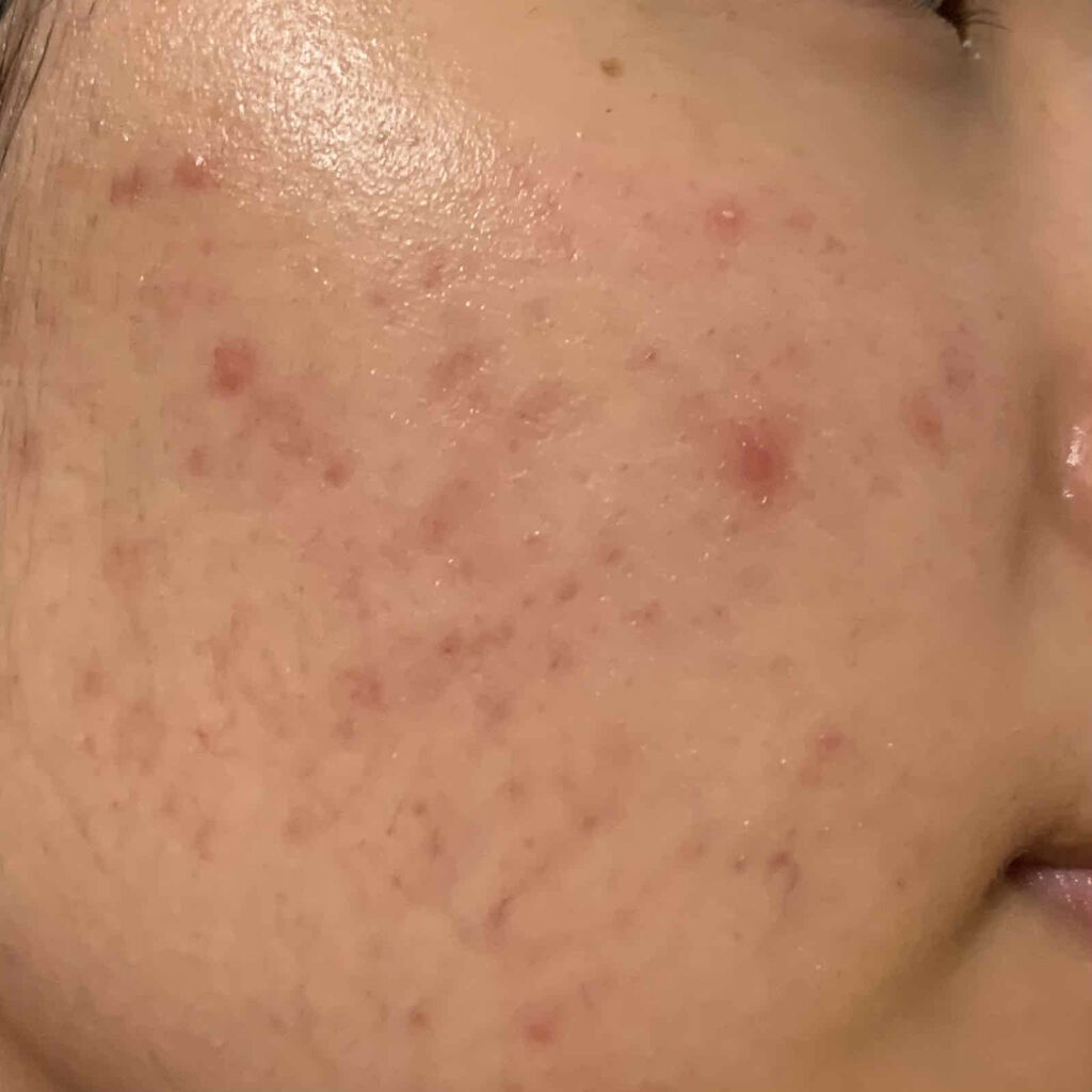 クリアモイスチャー M（しっとりタイプ）/オルビス/乳液を使ったクチコミ（3枚目）