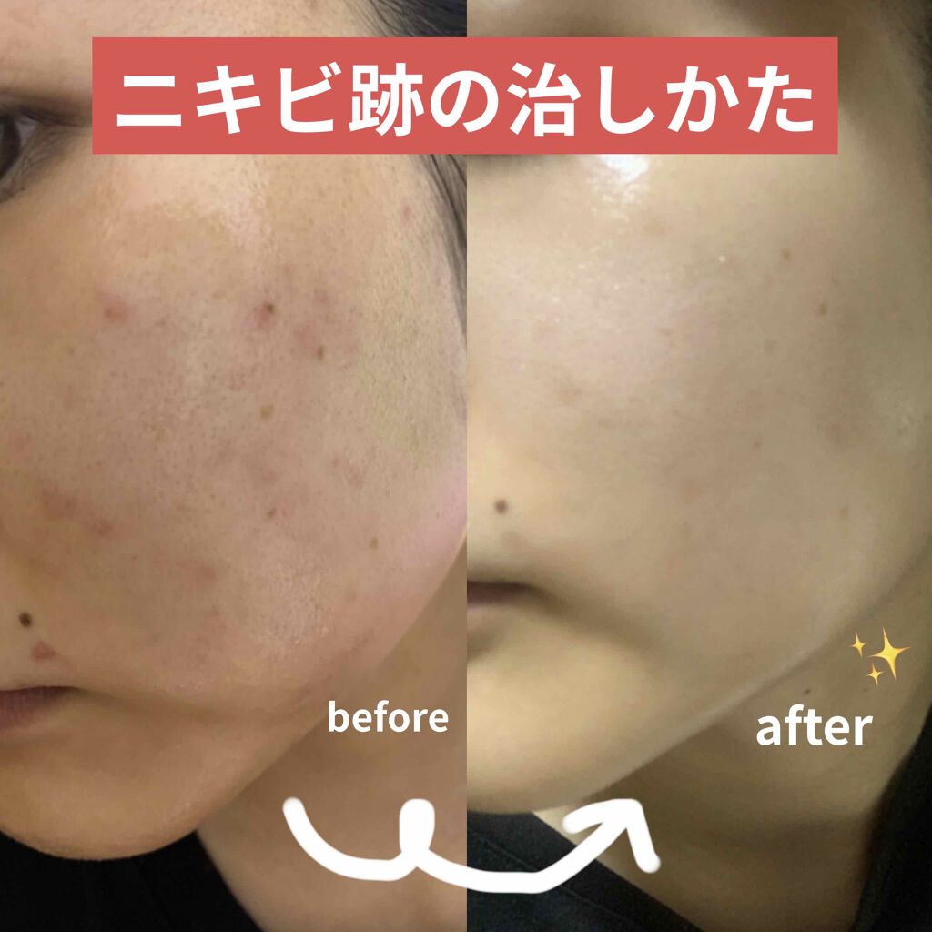 ペアアクネクリームW(医薬品)/ペア/その他を使ったクチコミ（1枚目）