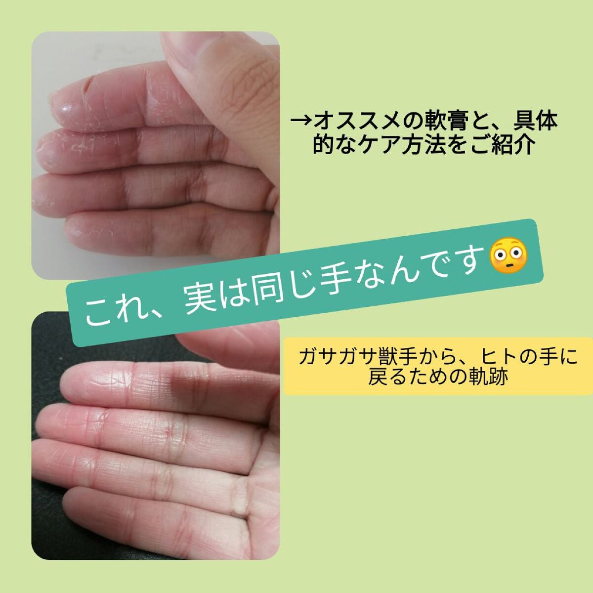 間宮アロエ軟膏(医薬品)/小林製薬/その他を使ったクチコミ(1枚目)