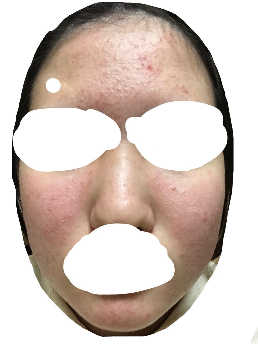 J on LIPS 「#ニキビ_肌断食1ヶ月と22日目です!自分の中での変化はわりと..」(4枚目)