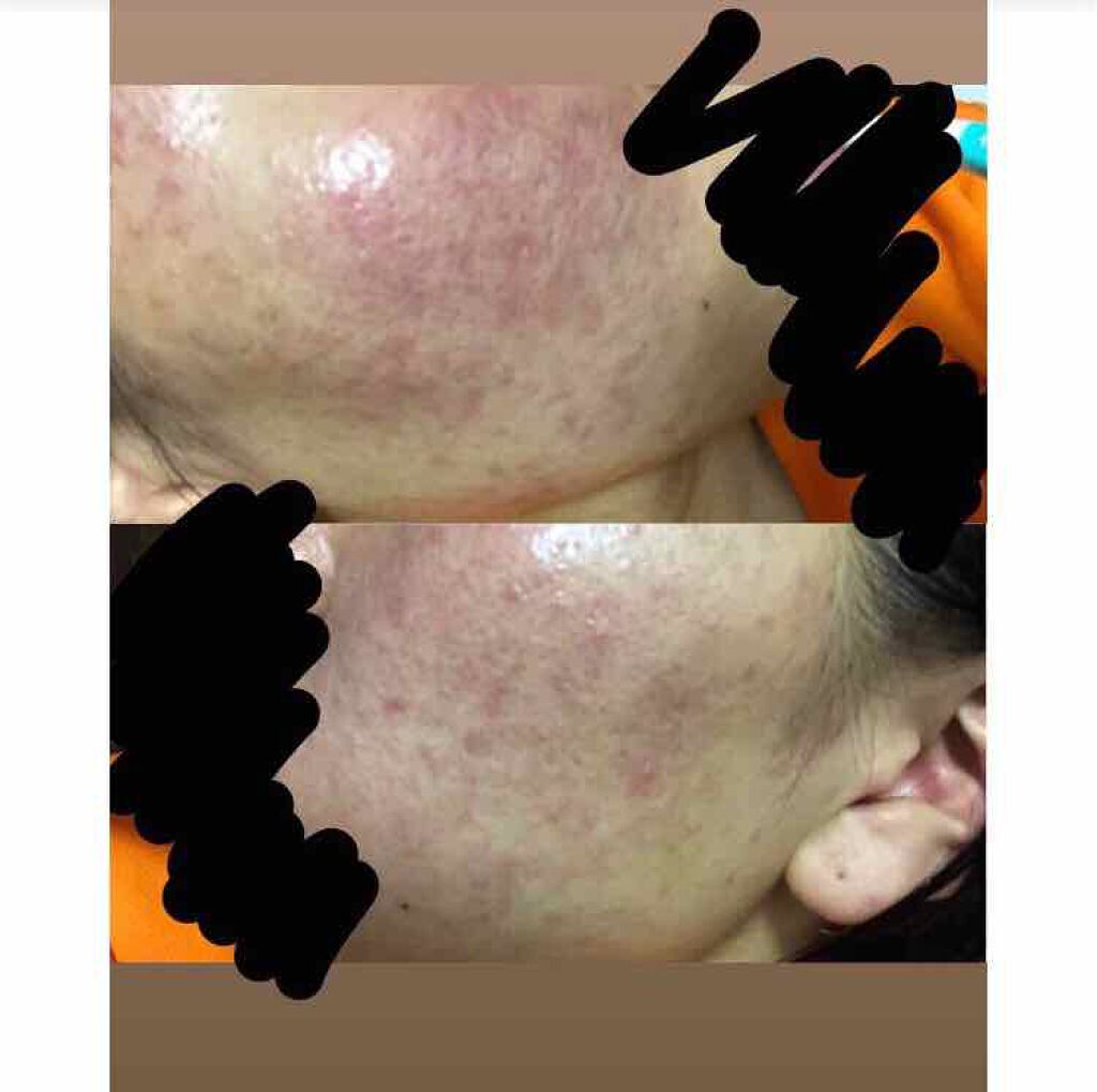 ヒルドイドローション 0.3% 50g/マルホ株式会社/その他を使ったクチコミ（1枚目）