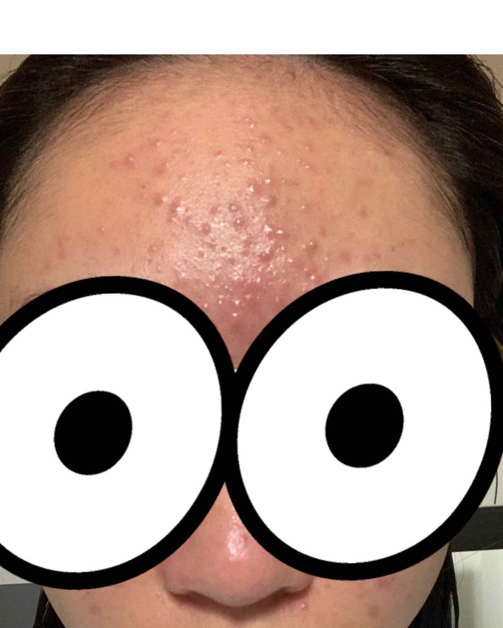 coral_glow_34g on LIPS 「元からニキビが酷かったですがいきなりこんなに酷くなってしまいま..」(2枚目)