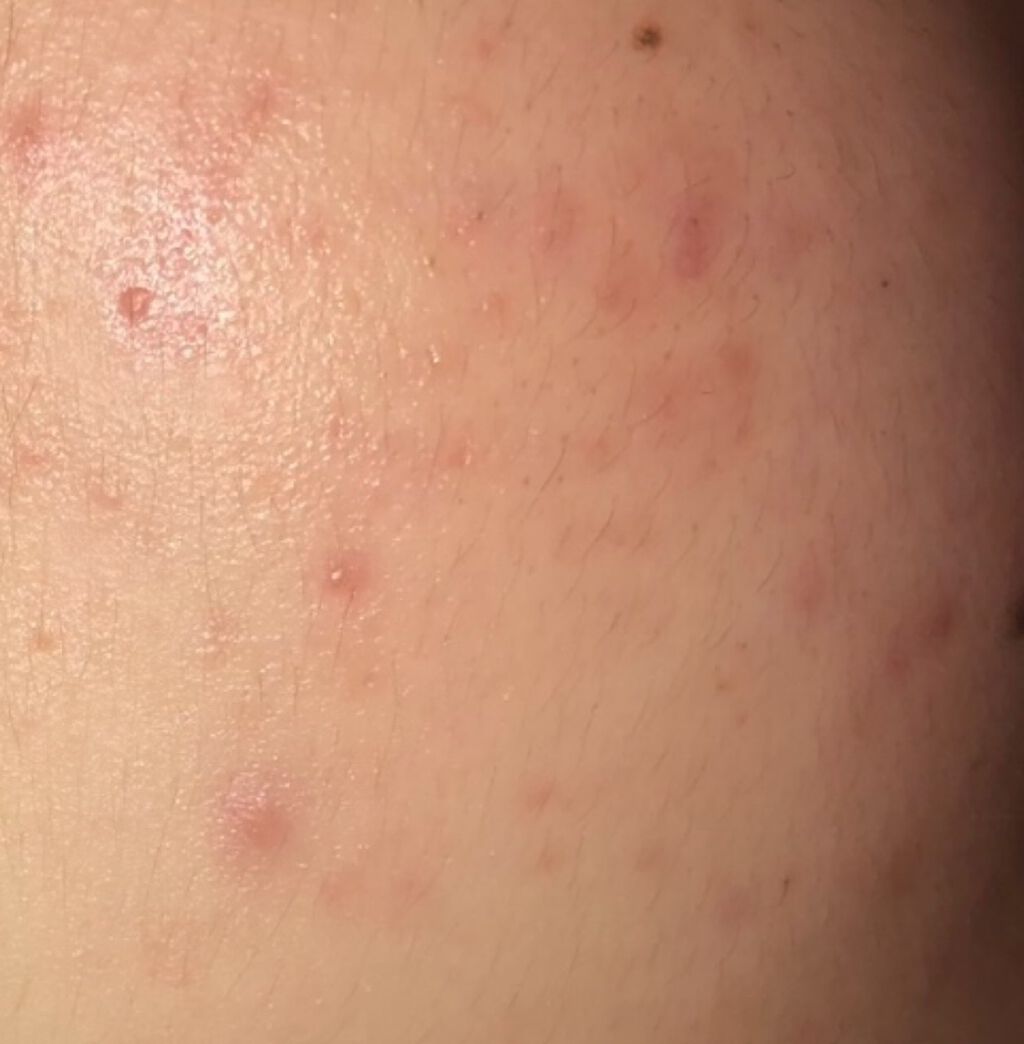 クラリファイング ローション 2/CLINIQUE/拭き取り化粧水を使ったクチコミ（2枚目）