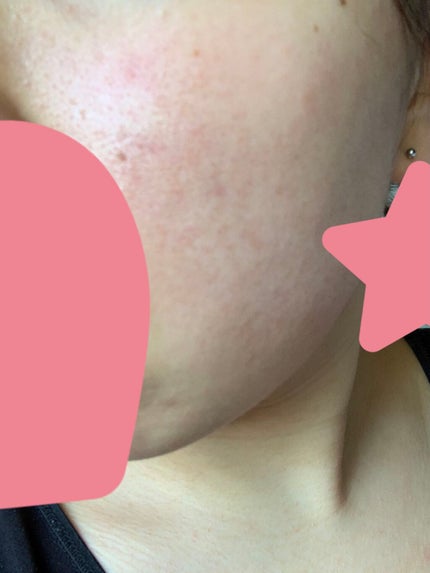 ティーツリーカーミングエッセンスパッド/MEDIHEAL/トナーパッドを使ったクチコミ(2枚目)