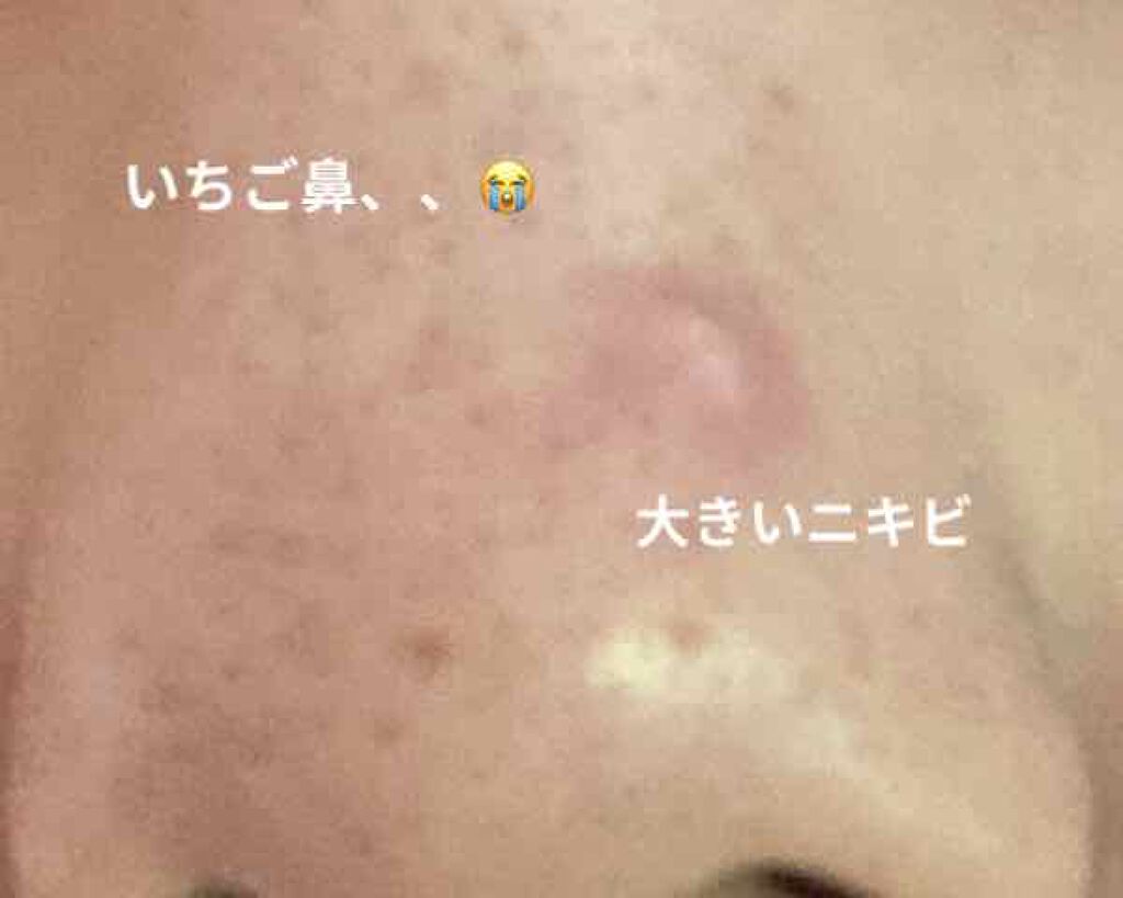 あお on LIPS 「私の肌は混合肌で敏感肌です😖鼻の上に大きなニキビが、、、😭口周..」(3枚目)