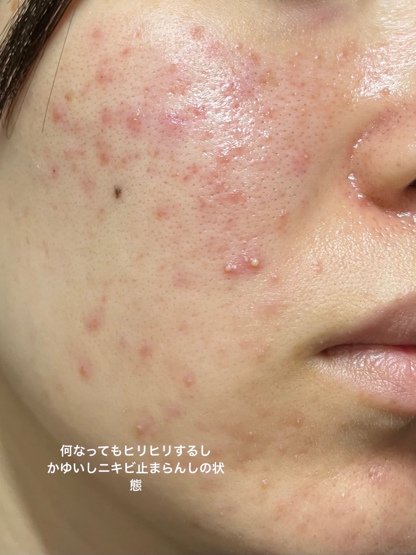 ビタペアC 集中美容液スペシャルセット/ネイチャーリパブリック/美容液を使ったクチコミ(3枚目)