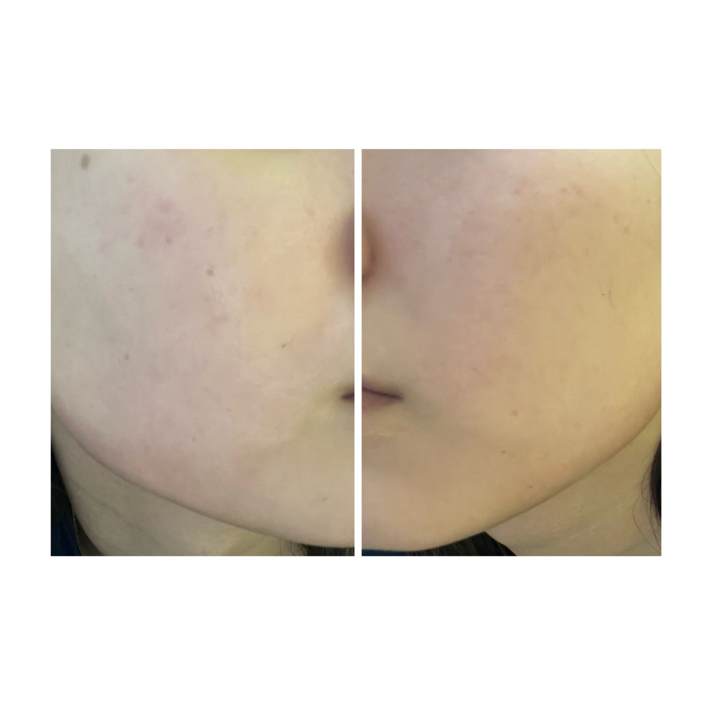 ぽむ on LIPS 「2023.9.13皮膚科に受診 エピデュオとヘパリン処方1枚目..」(1枚目)