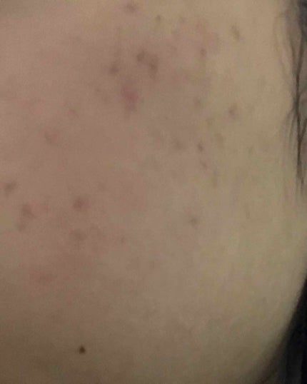 バイオイル/バイオイル/フェイスオイルを使ったクチコミ(2枚目)