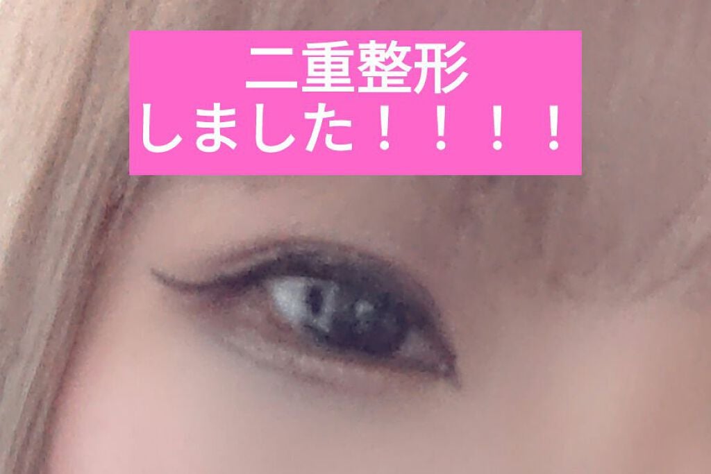 まり@大人な女性になりたい34歳 on LIPS 「ついに!二重整形しました!!!!!高校生からずっ~~~と悩んで..」(1枚目)
