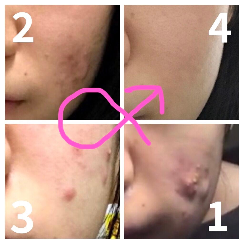 オードムーゲ 薬用ローション(ふきとり化粧水)/オードムーゲ/拭き取り化粧水を使ったクチコミ(3枚目)