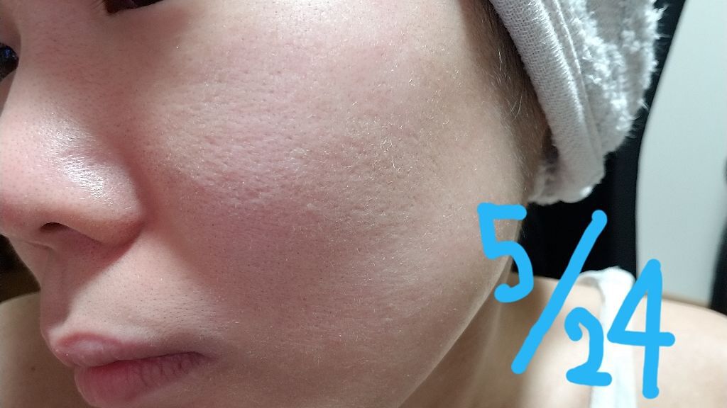 ルルルンプレシャス RED(モイスト)【旧】/ルルルン/シートマスク・パックを使ったクチコミ(3枚目)