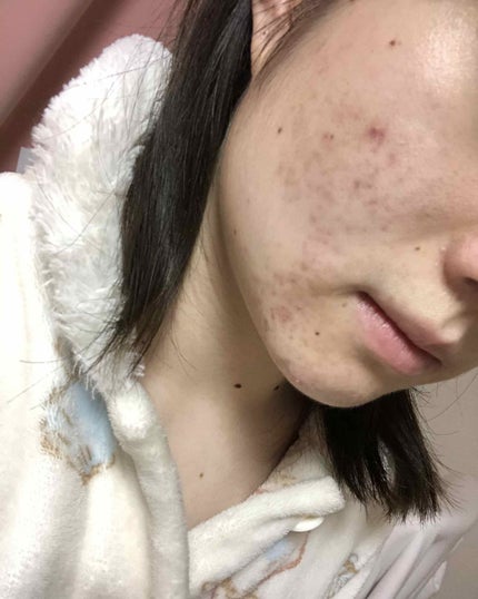 バイオイル/バイオイル/フェイスオイルを使ったクチコミ(4枚目)