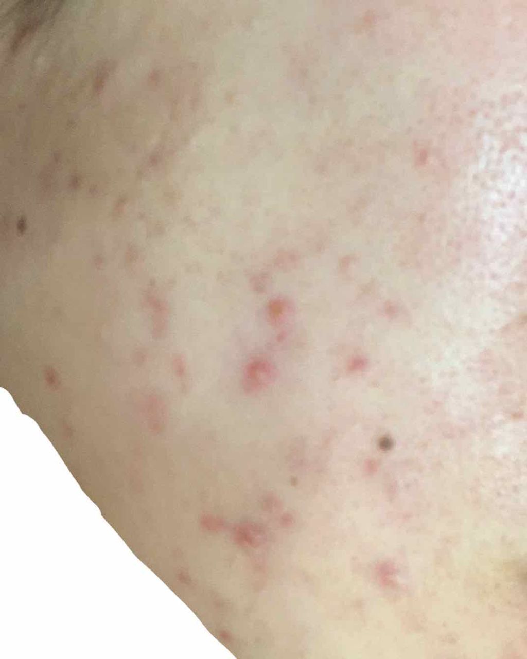 ペアアクネクリームW(医薬品)/ペア/その他を使ったクチコミ（2枚目）