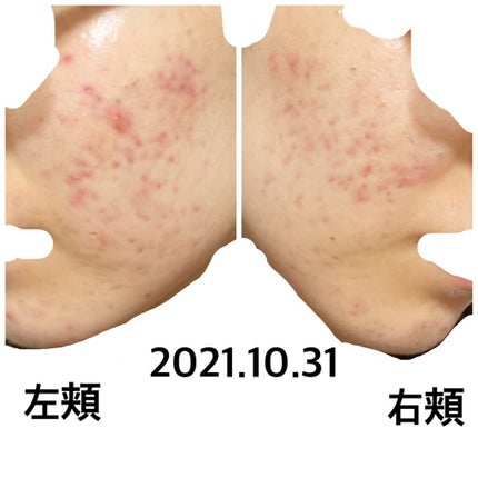 ペアA錠 (医薬品)/ペア/その他を使ったクチコミ(1枚目)