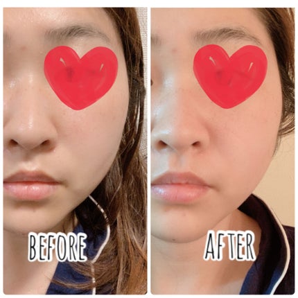 ジュエリアプレミアム マイクロパッチ/ジュエリアプレミアム/シートマスク・パックを使ったクチコミ(5枚目)