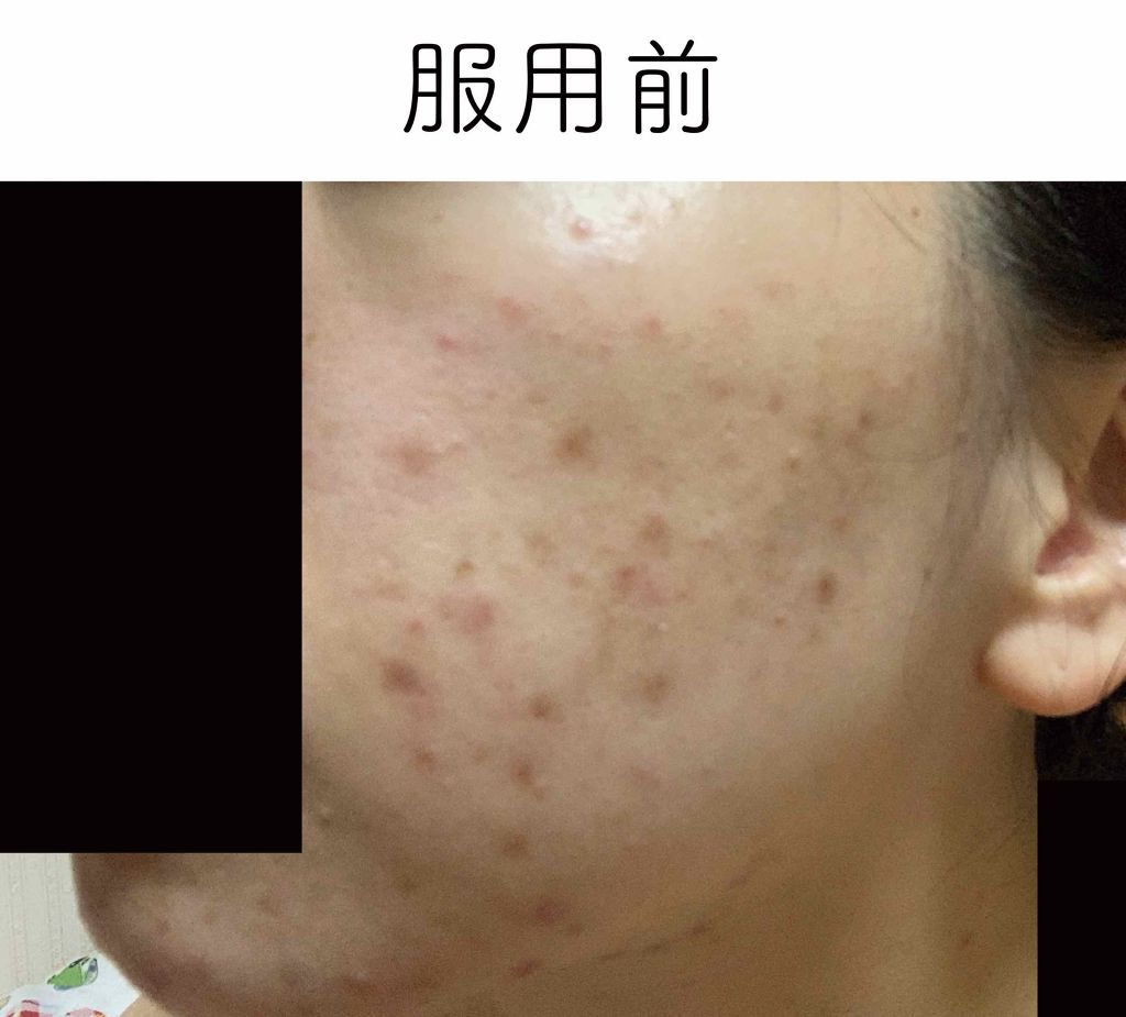 リポスフェリック ビタミンＣ（リポソーム ビタミンC）/Lypo-Spheric/美容サプリメントを使ったクチコミ（2枚目）