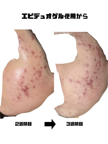 みこ on LIPS 「【ニキビ治療経過記録】閲覧注意です!!エピデュオゲルやその他も..」(2枚目)