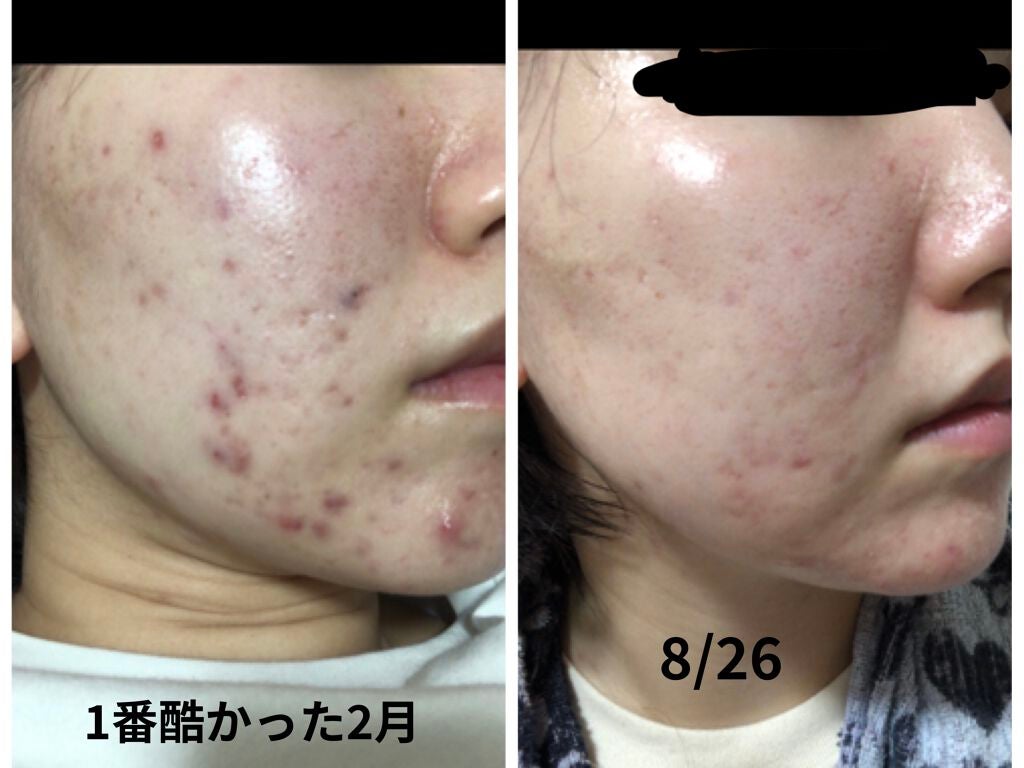 ティーツリーケア ソリューション エッセンシャルマスクEX/MEDIHEAL/シートマスク・パックを使ったクチコミ(2枚目)