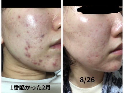 ティーツリーケア ソリューション エッセンシャルマスクEX/MEDIHEAL/シートマスク・パックを使ったクチコミ(2枚目)