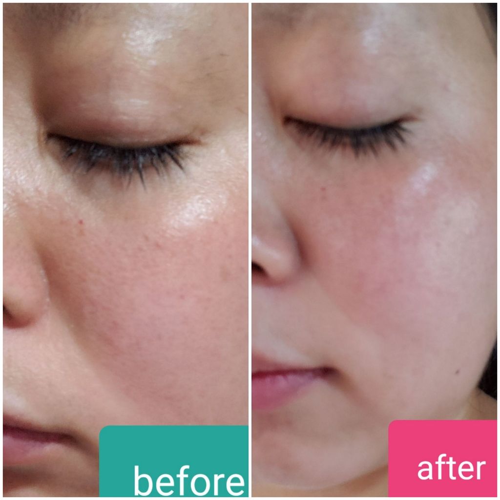 タカミスキンピール/タカミ/ブースター・導入液を使ったクチコミ(2枚目)