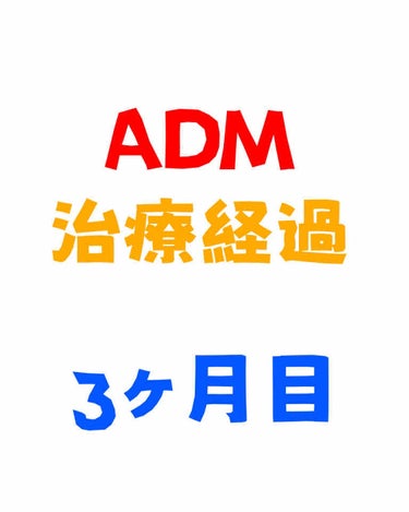 【ADM治療3ヶ月目】

レーザー照射3ヶ月経ちました。
（前回投稿　#後天性真皮メラノサイトーシス）

ハイドロキノン塗布は、3/10くらいから止めました。
なので、1ヶ月と2週間ほど使用しました。
