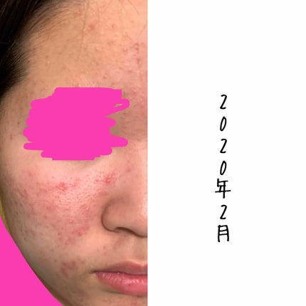 ベピオゲル/マルホ株式会社/その他を使ったクチコミ(2枚目)