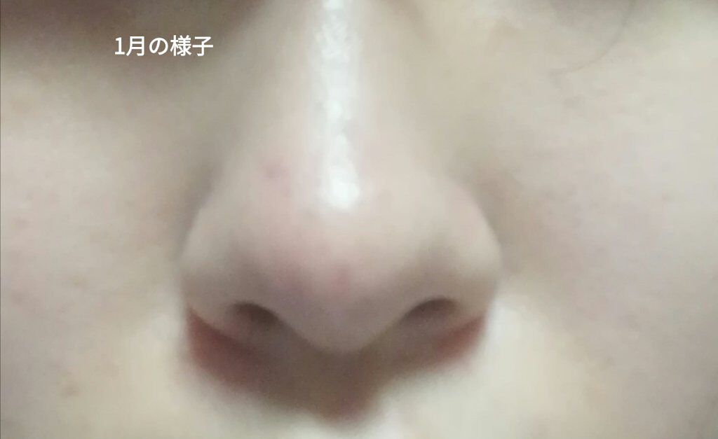 薬用保湿化粧水/オードムーゲ/化粧水を使ったクチコミ(7枚目)