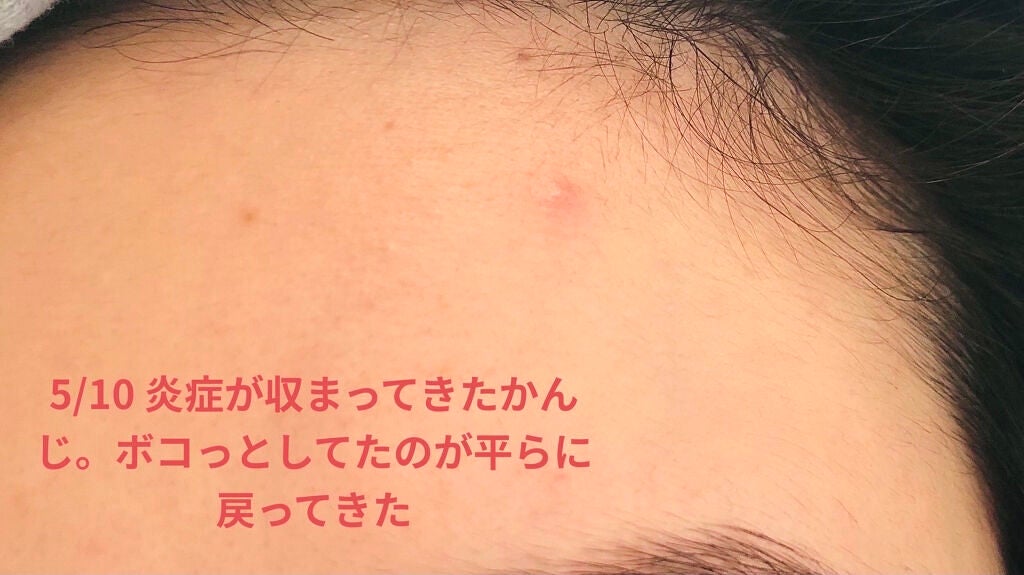 薬用 しみ 集中対策 美容液/メラノCC/美容液を使ったクチコミ(6枚目)