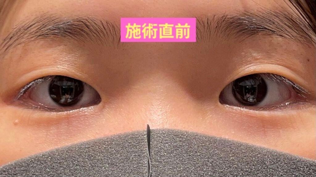 ㄘょƕ on LIPS 「#二重整形#湘南美容外科#クイックコスメティーク法ダブル本日、..」(1枚目)