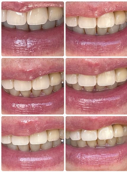 アパガードセレナ/アパガード/歯磨き粉を使ったクチコミ(3枚目)