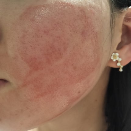 AHA 30% + BHA 2% Peeling Solution/The Ordinary/ピーリングを使ったクチコミ(2枚目)