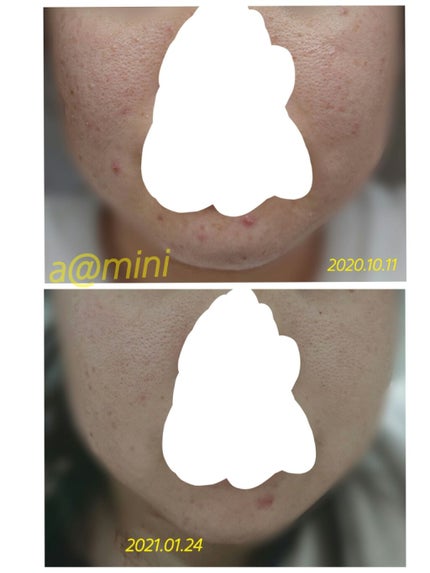 プラセンタエキス原液/fracora/美容液を使ったクチコミ(4枚目)