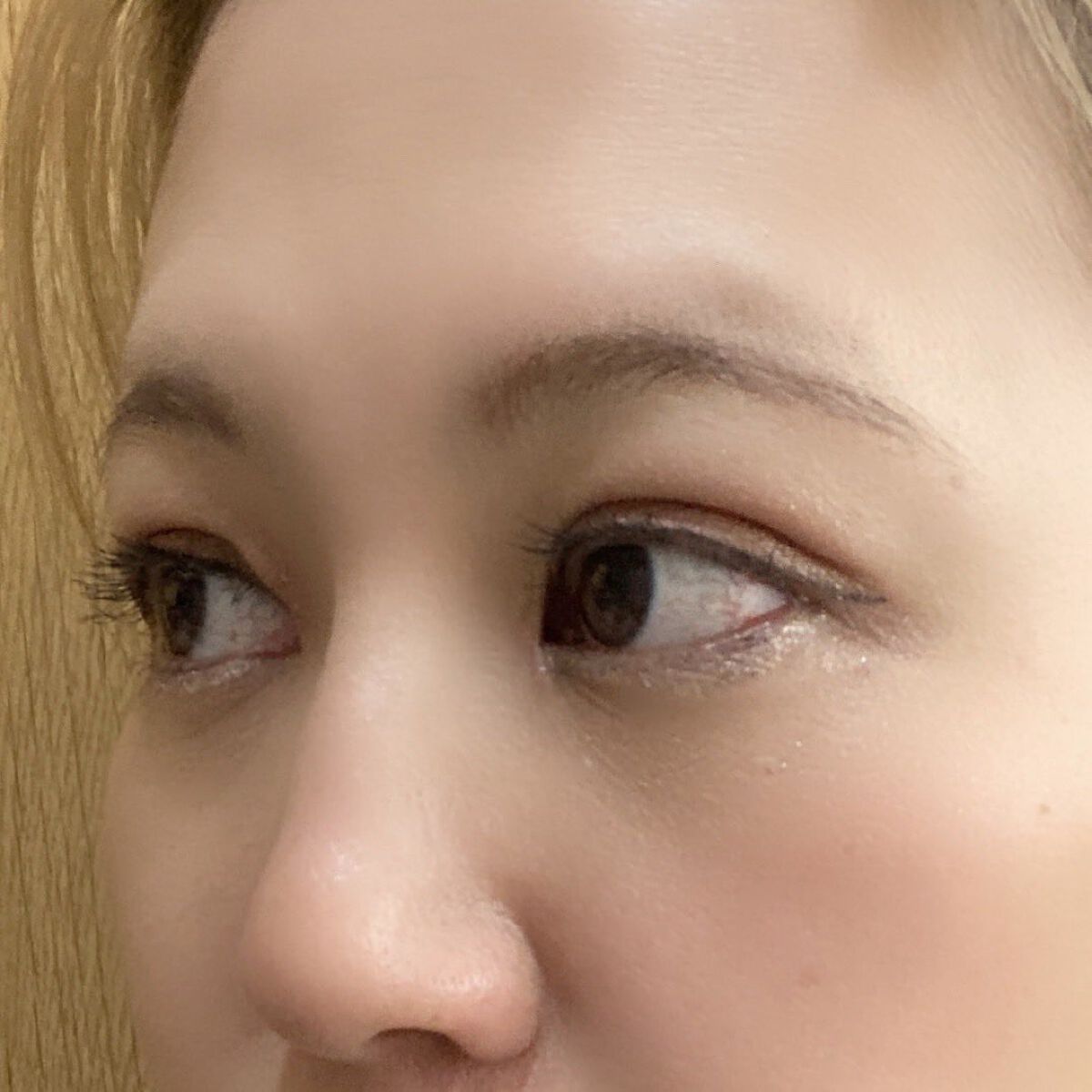 ふうせん @フォロバ100% on LIPS 「4月7日金曜日施術してから6週間が経ったよ❣️前回、1ヶ月検診..」(3枚目)