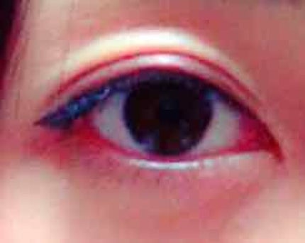 さいきc 治療クリーム(医薬品)/Saiki/その他を使ったクチコミ(1枚目)