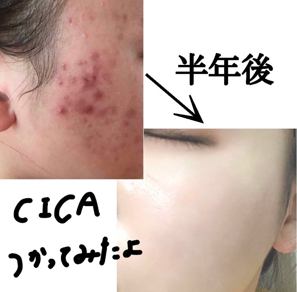 CICA デイリースージングマスク/VT/シートマスク・パックを使ったクチコミ（1枚目）