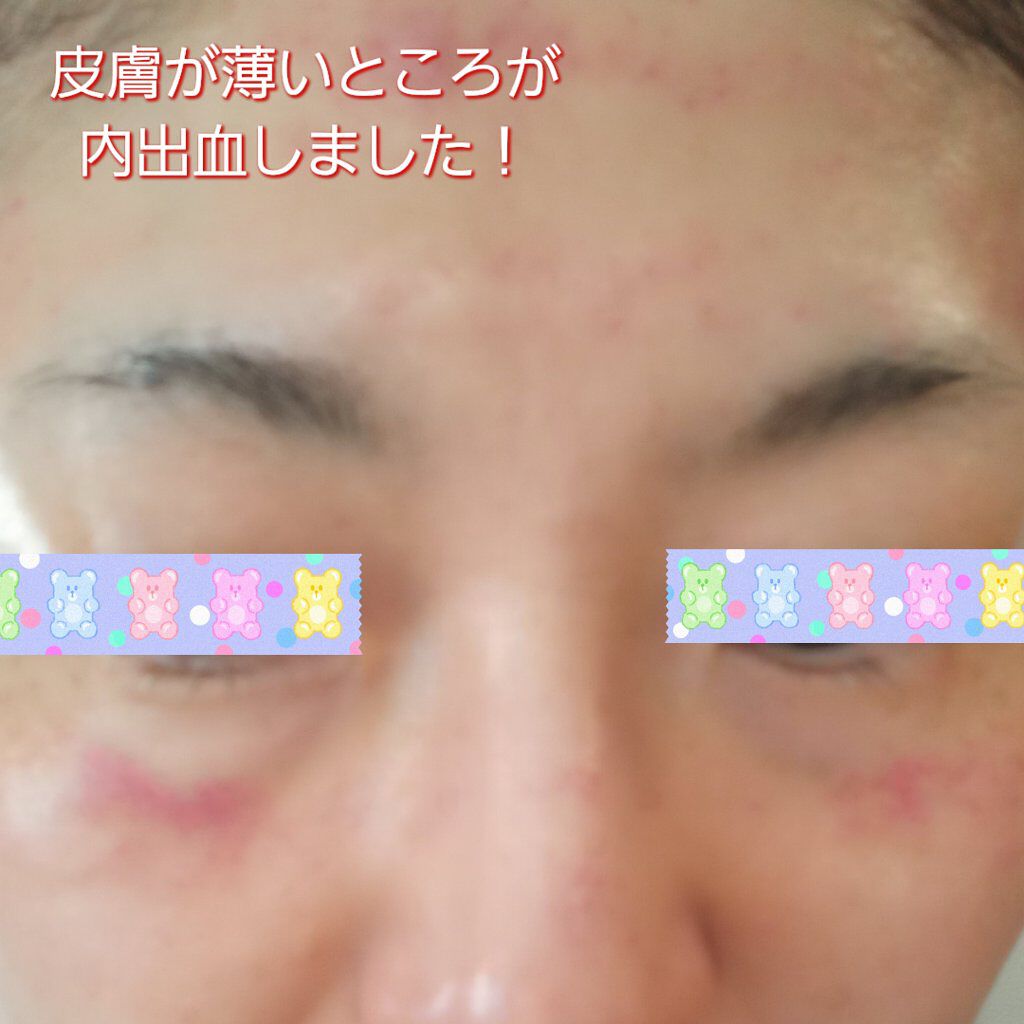 ダーマペン・ダーマスタンプ/MyM/その他スキンケアグッズを使ったクチコミ（2枚目）