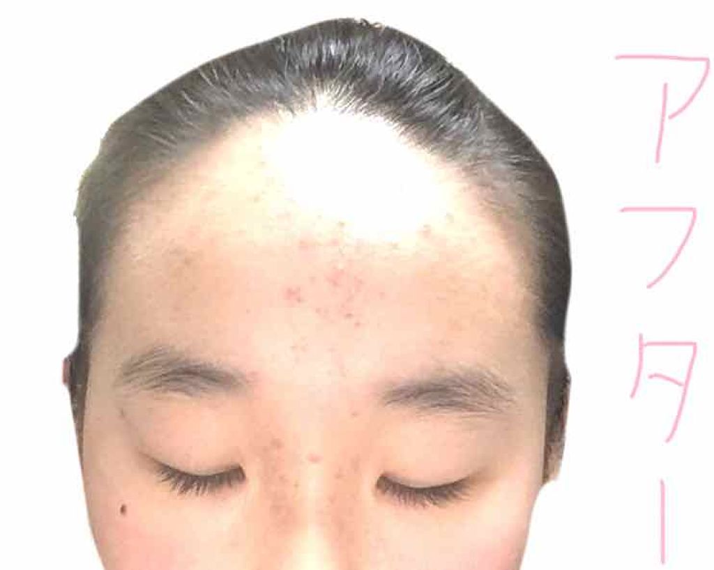 A アクネフォーム/NOV/洗顔フォームを使ったクチコミ（2枚目）