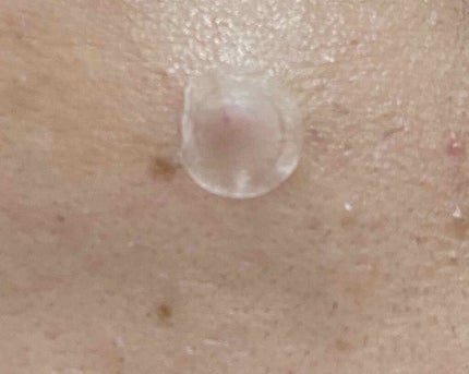 ACC パッチ/ETUDE/シートマスク・パックを使ったクチコミ(4枚目)