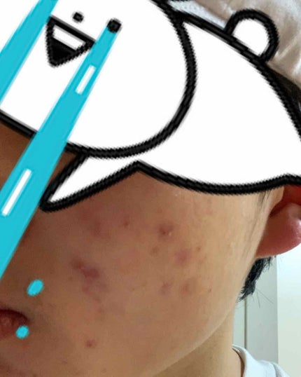 アクネキュアクリーム(医薬品)/IHADA/その他を使ったクチコミ(1枚目)