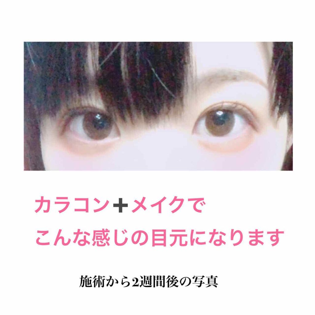 ゆず汰 on LIPS 「二重整形(埋没法)から1ヶ月以上経ちました!ダウンタイムの様子..」(4枚目)