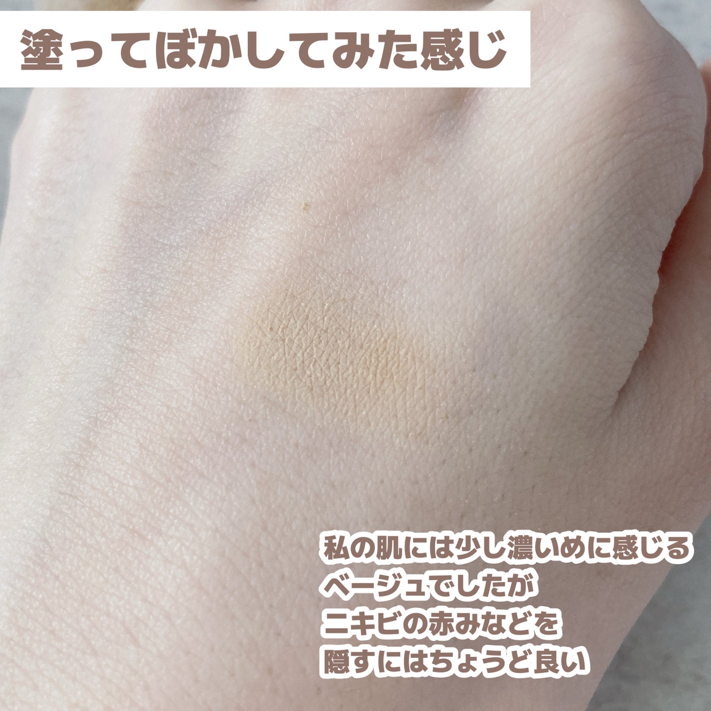 薬用コンシーラー アクネプロテクター/ONLY MINERALS/パウダーコンシーラーを使ったクチコミ(6枚目)