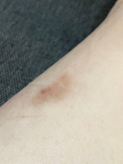 さいきa 保水治療ローション(医薬品)/Saiki/その他を使ったクチコミ(9枚目)