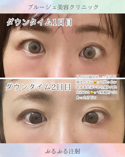 ちっちみ on LIPS 「*☂︎*̣̩⋆プルージュ美容クリニック(@pruge_clin..」(5枚目)