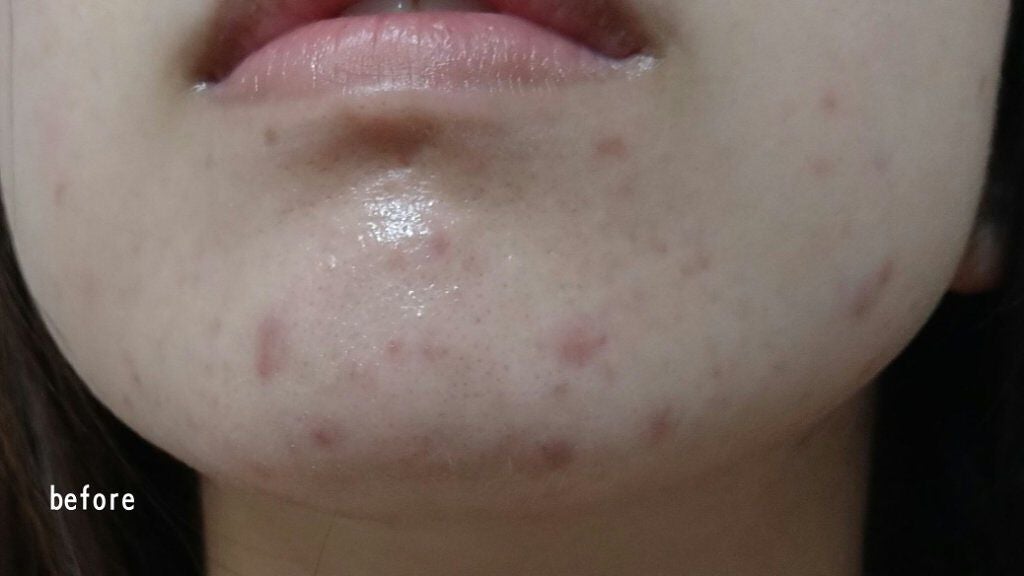 チョコラBBプラス (医薬品)/チョコラBB/その他を使ったクチコミ(4枚目)