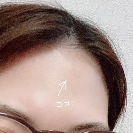 クリアパッチ/Angelab/にきびパッチを使ったクチコミ(3枚目)