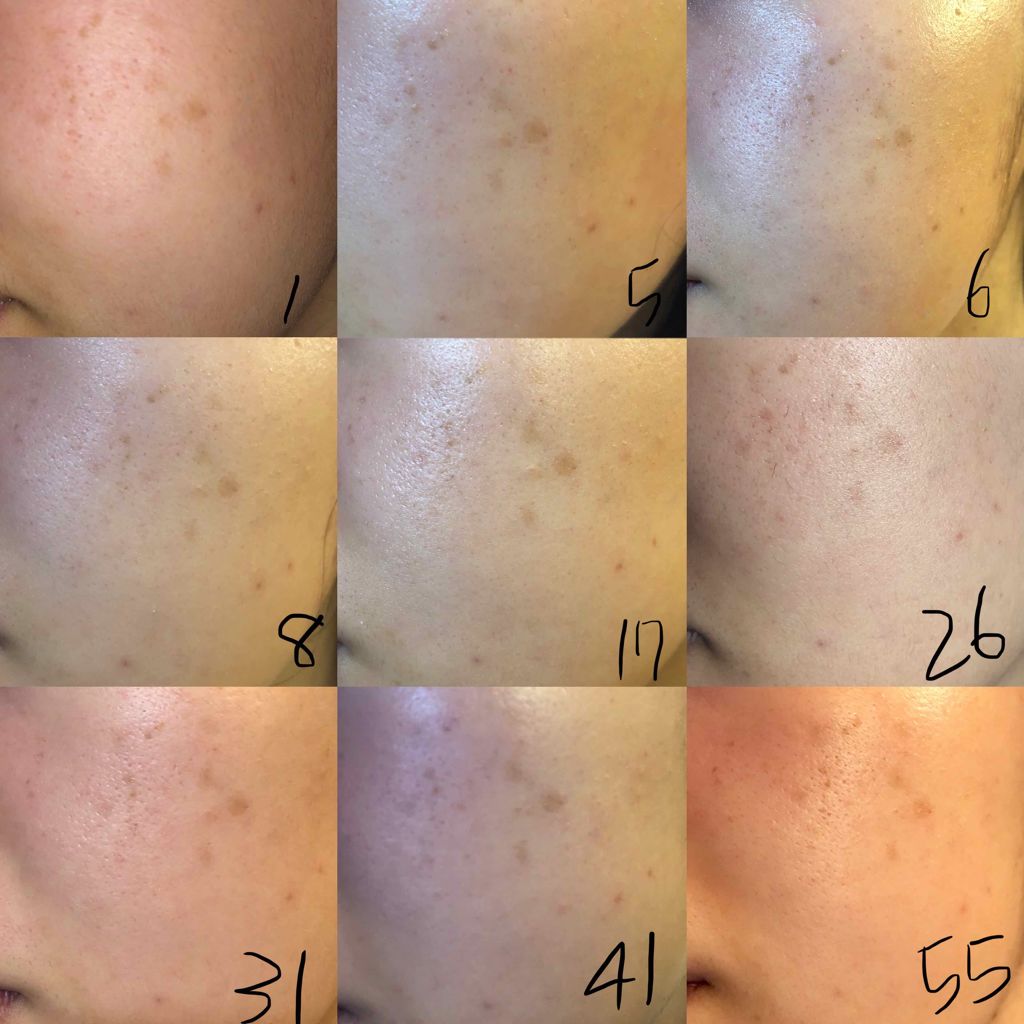 薬用 しみ 集中対策 美容液/メラノCC/美容液を使ったクチコミ(3枚目)